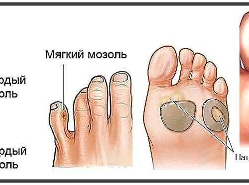 Удаление и лечение мозолей | Отделение платных медицинских услуг КДЦ №6