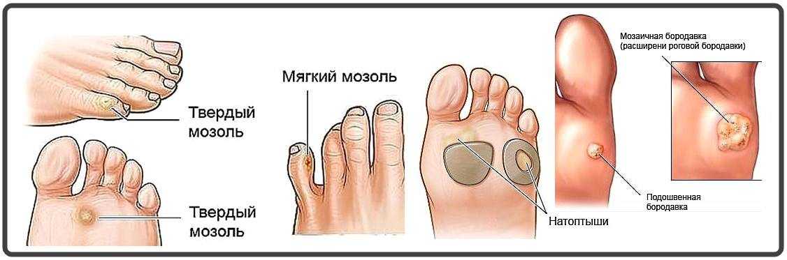 Удаление и лечение мозолей | Отделение платных медицинских услуг КДЦ №6